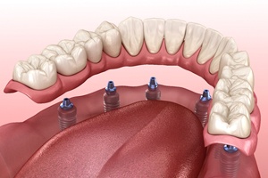 graphic of implant denture in Waterford